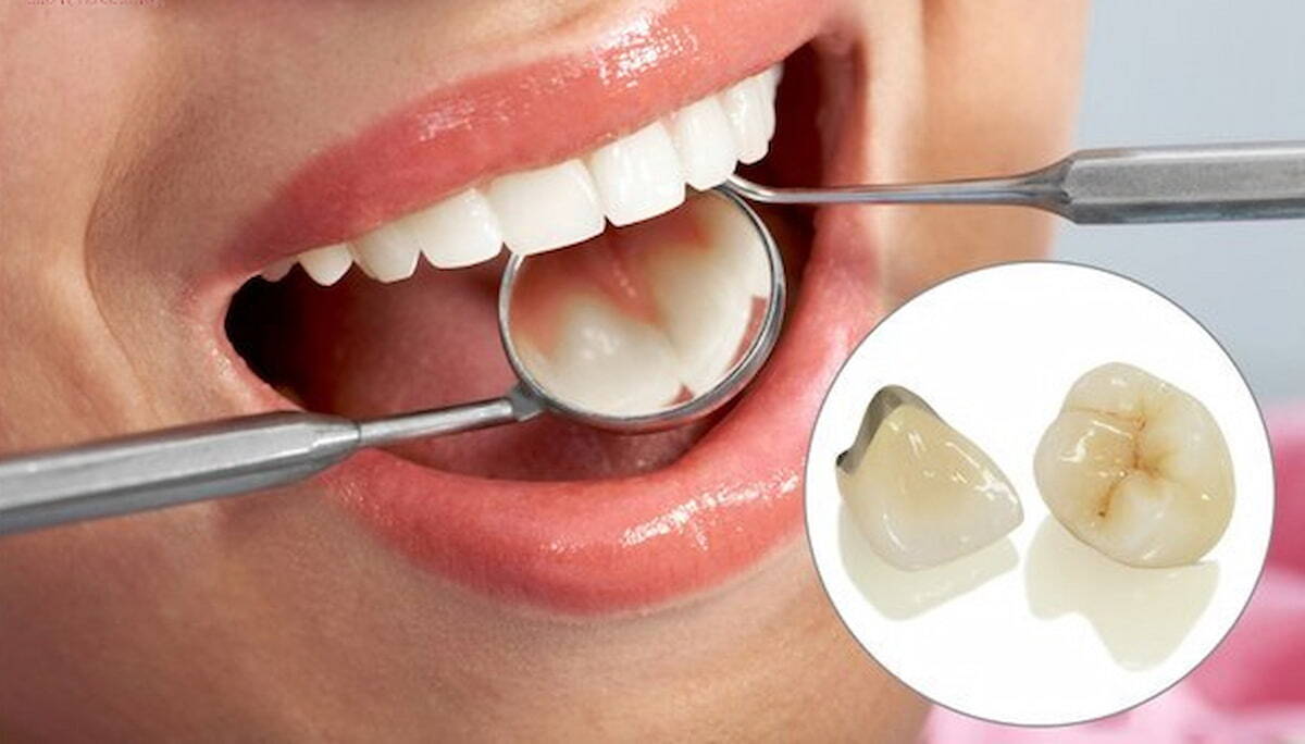 Trường hợp nên bọc răng sứ