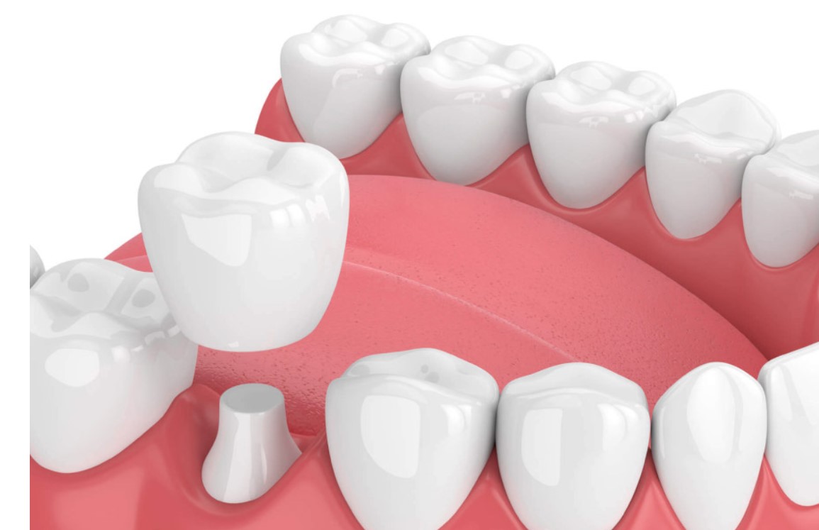 Platinum Dental là địa chỉ bọc răng sứ hàng đầu tại TP. HCM