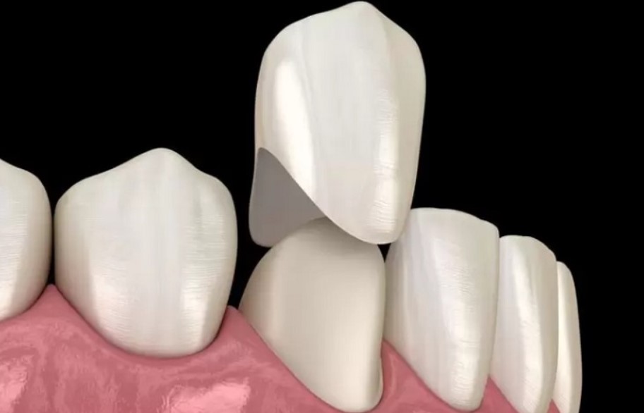 Tháo răng sứ ra lắp lại có ảnh hưởng gì không?