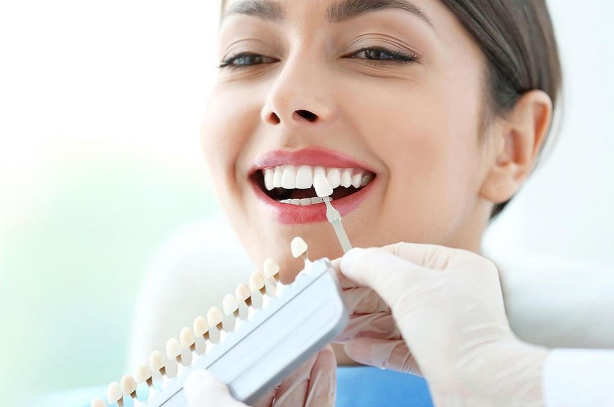 Keo dán răng sứ mua ở đâu?