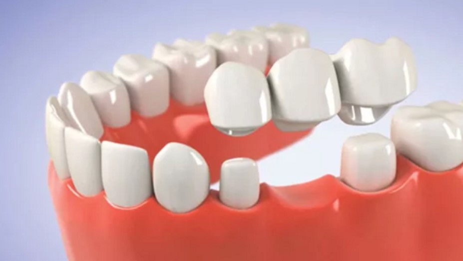 Làm cầu răng sứ giá bao nhiêu?