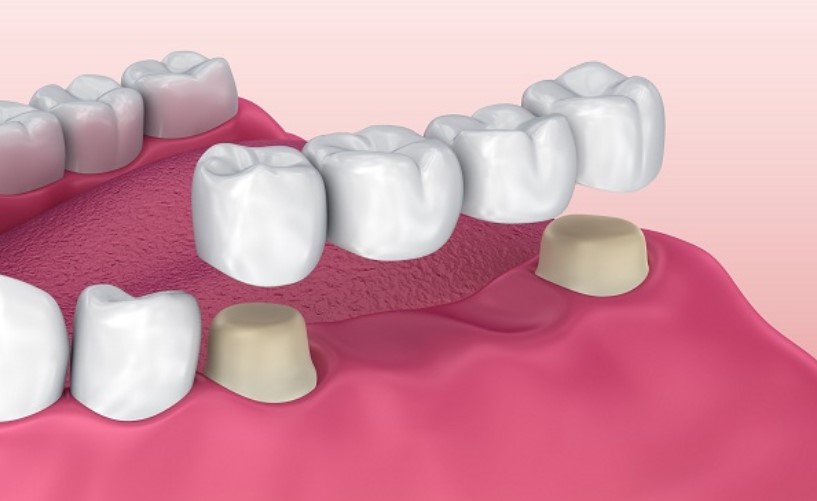 Số lượng mão răng sứ cần phục hình