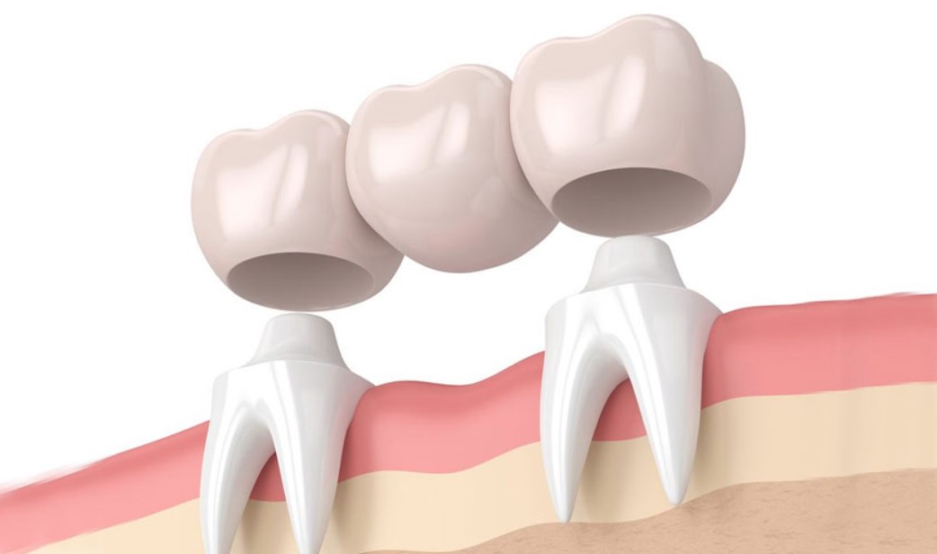 Nhược điểm của cầu răng sứ