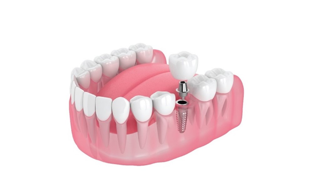 Trồng răng Implant khắc phục cầu răng sứ như thế nào