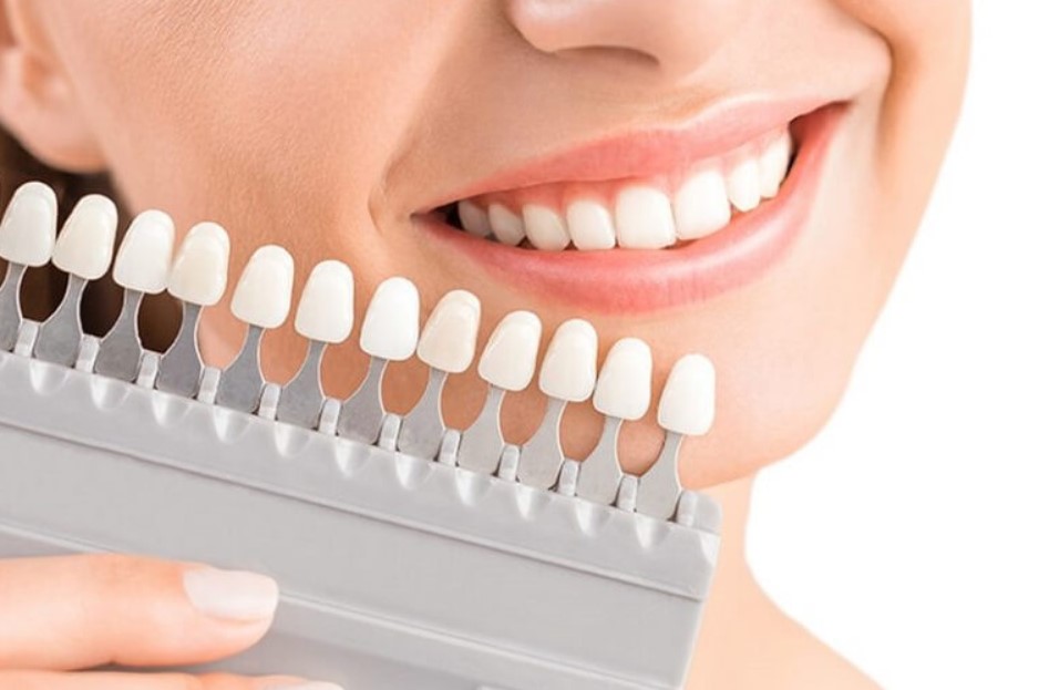 Phủ răng sứ có tốt không?