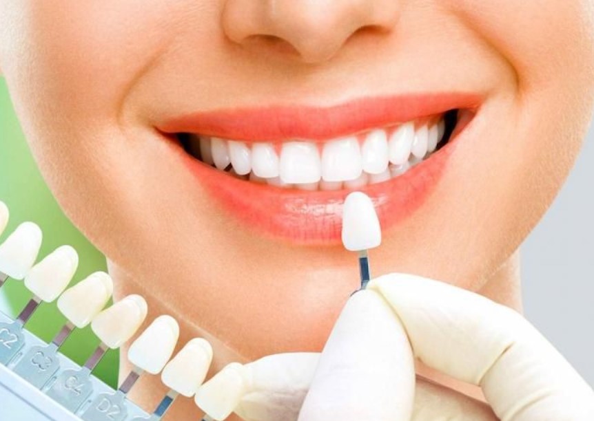 Phủ răng sứ có bền không?