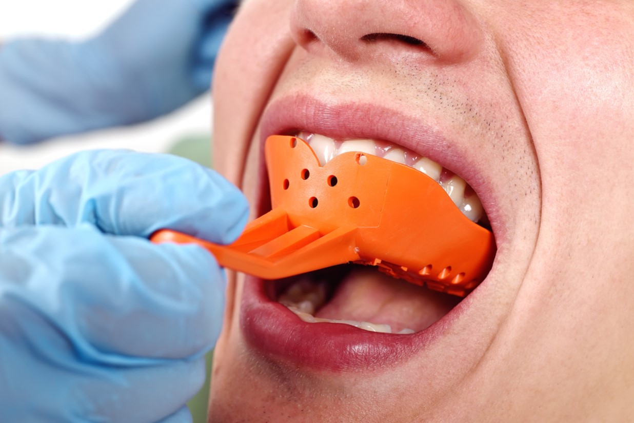 Lấy dấu hàm làm răng mẫu và gửi về phòng Labo