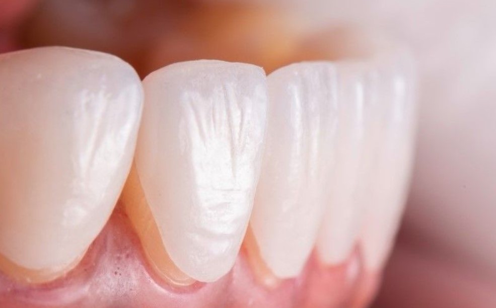 Răng sứ Lisi có tốt không?