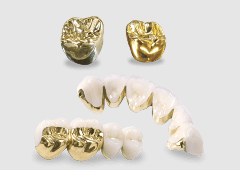 Đối tượng phù hợp bọc răng sứ quý kim