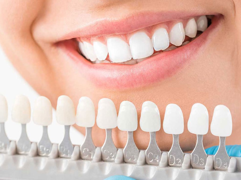 Quy trình gắn răng tạm khi làm răng sứ tại Platinum Dental