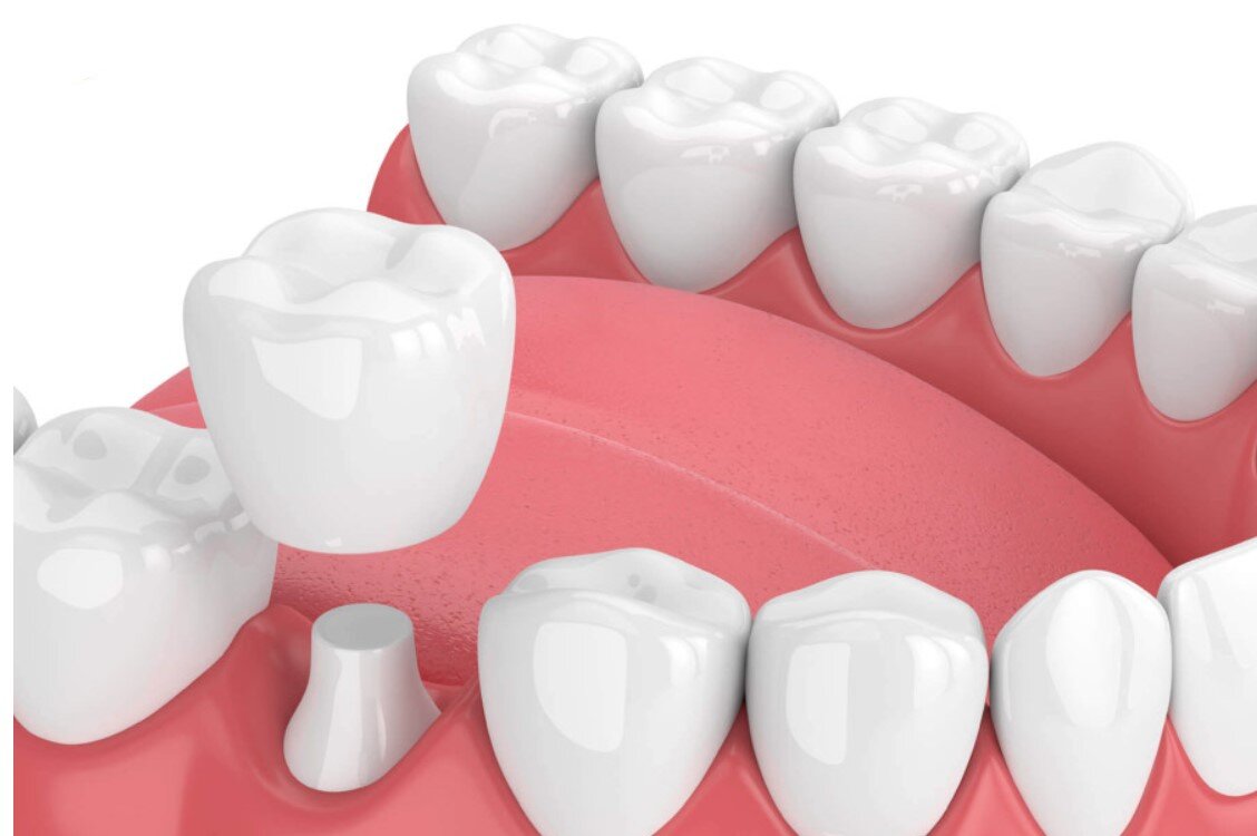 Bọc răng sứ 1 chiếc được không?