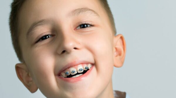 Cải thiện nụ cười với niềng răng trẻ em