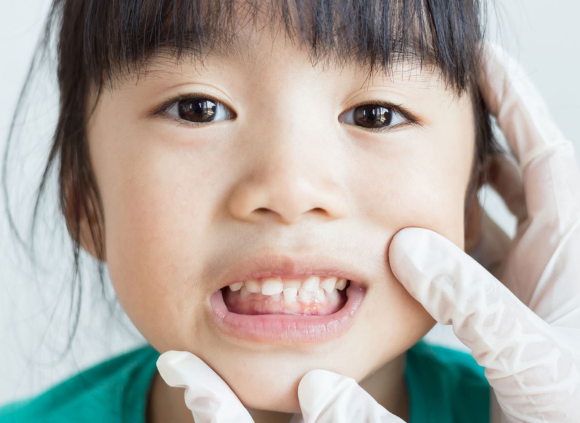 Chi tiết các bước niềng răng trẻ em