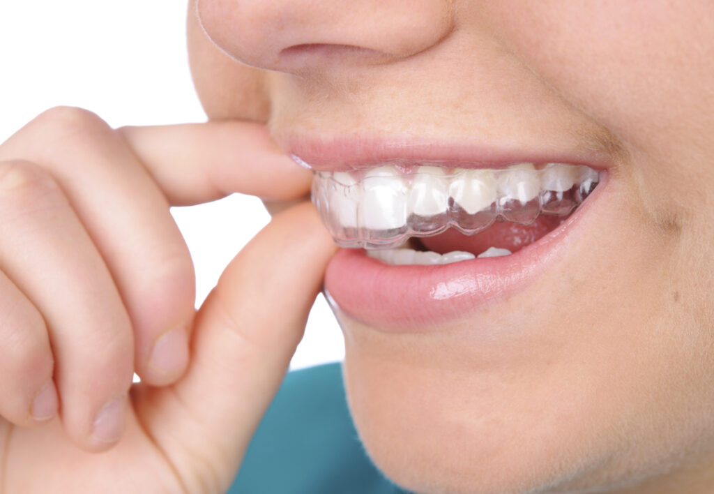 Phương pháp chỉnh nha hiệu quả