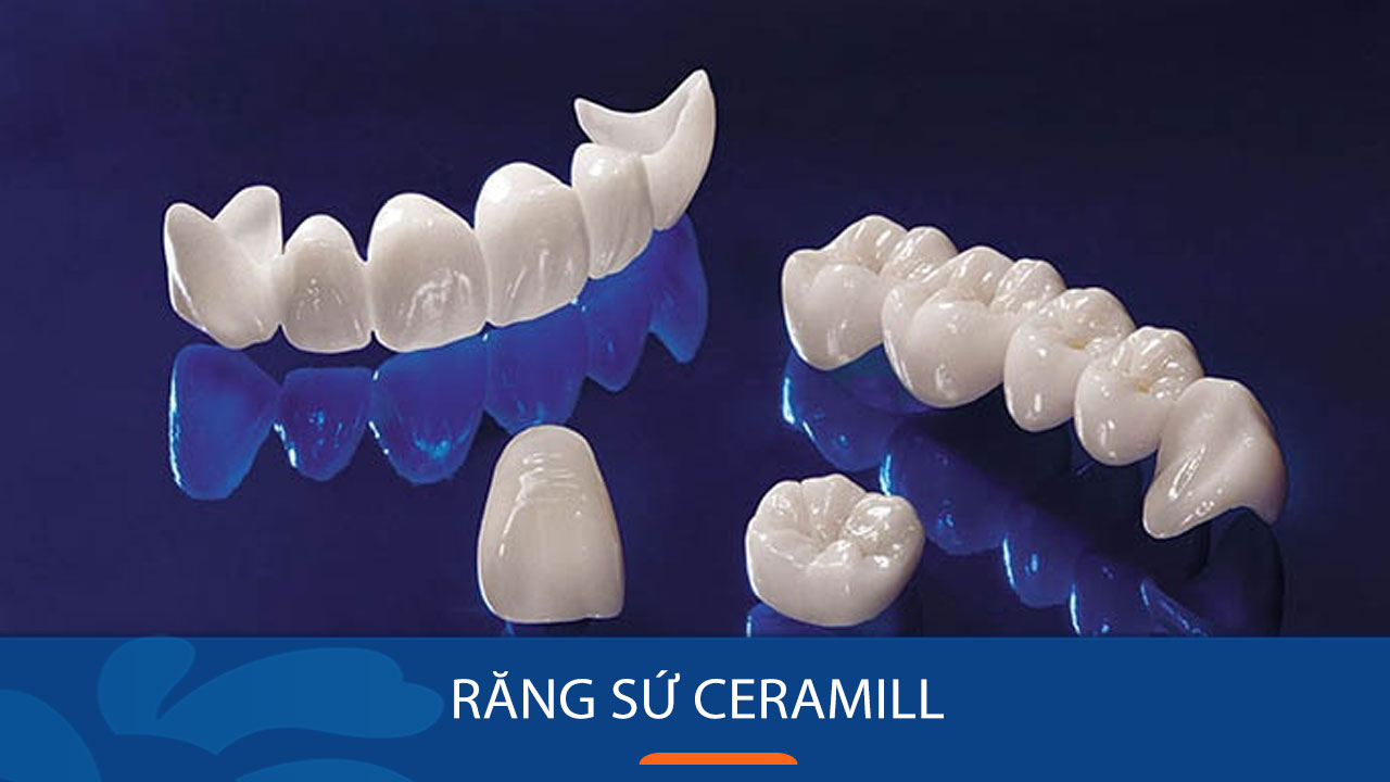 Răng toàn sứ Ceramill có 2 loại chính