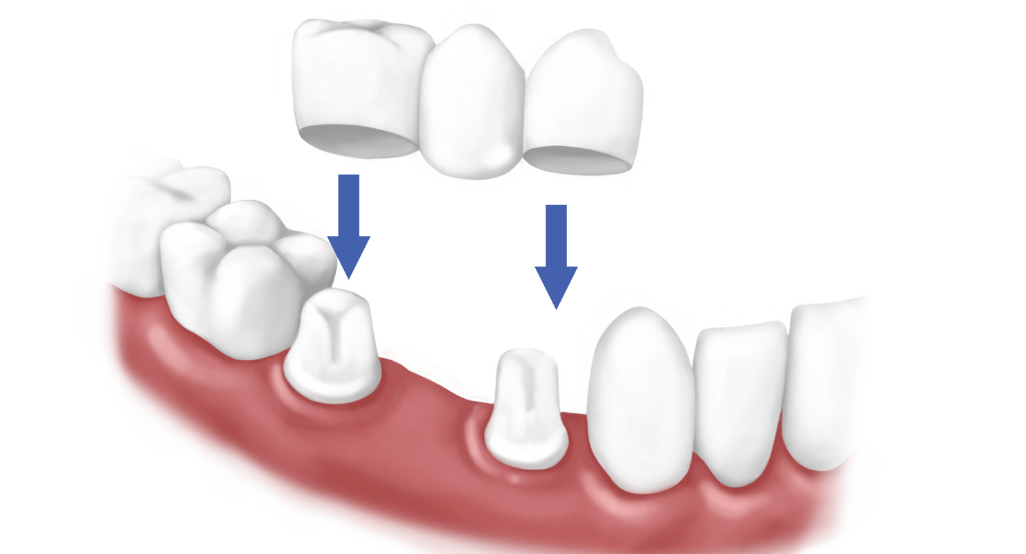 Phương pháp thay thế răng bị mất