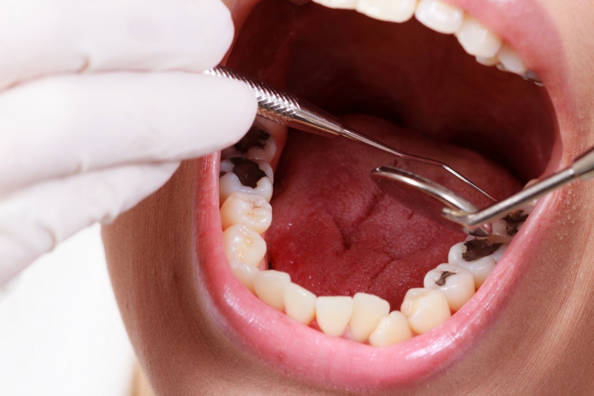 Yếu tố quyết định niềng răng sau bọc răng sứ