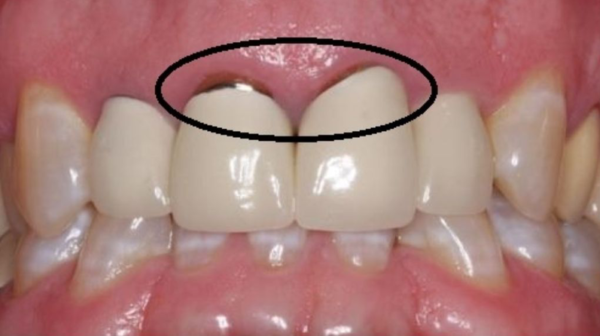 bọc răng sứ bị đen nướu