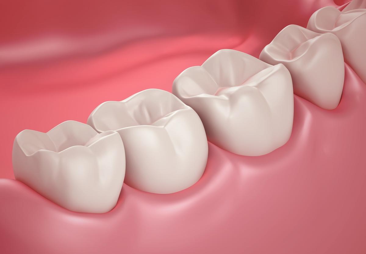 Bọc răng sứ bị đen nướu do kỹ thuật không chuẩn