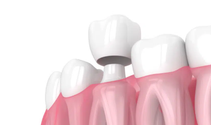 Mão răng sứ có thể bị chật theo thời gian