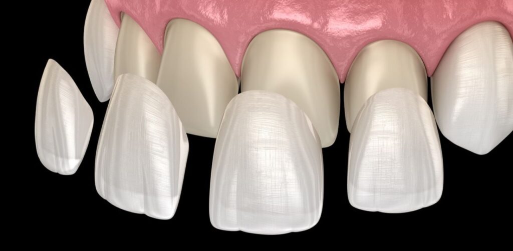 Mài răng dán sứ Veneer