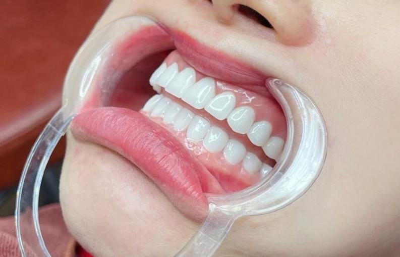Răng sứ Orodent là gì