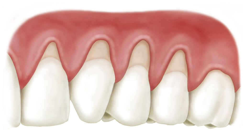 Trường hợp dán sứ Veneer không mài răng