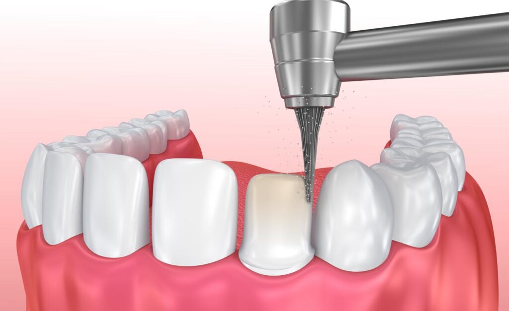 Ưu điểm dán sứ Veneer không mài răng