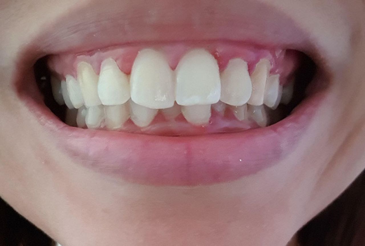 Bọc răng sứ cho trường hợp răng hô nhẹ