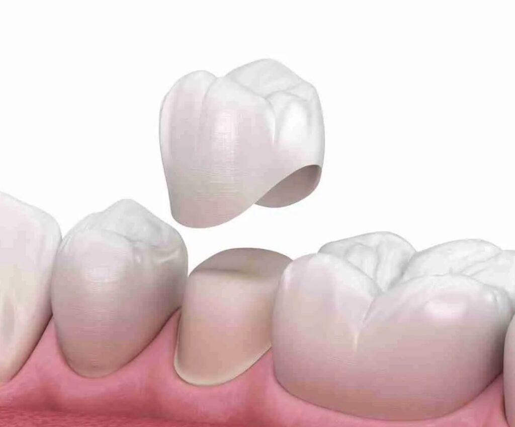 Các trường hợp nên chụp răng sứ