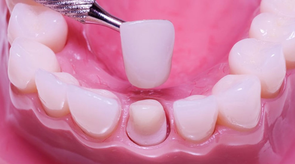 Chi phí bọc răng sứ trả góp