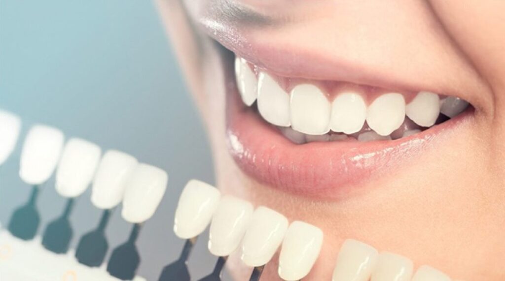 Các tông màu răng sứ phổ biến hiện nay