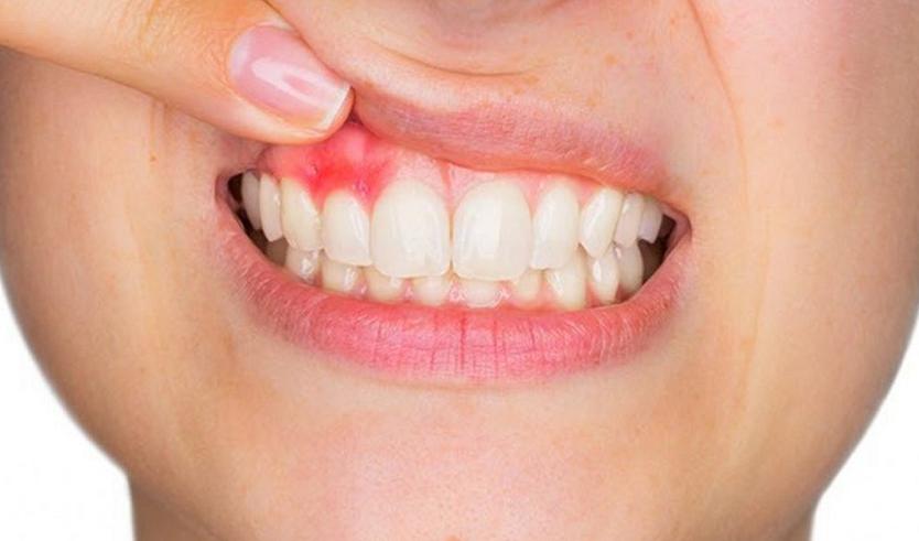 Nguyên nhân làm cho bọc răng sứ bị viêm lợi