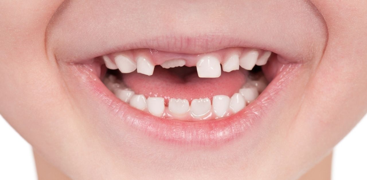 Răng sữa lung lay làm bé khó khăn khi giao tiếp