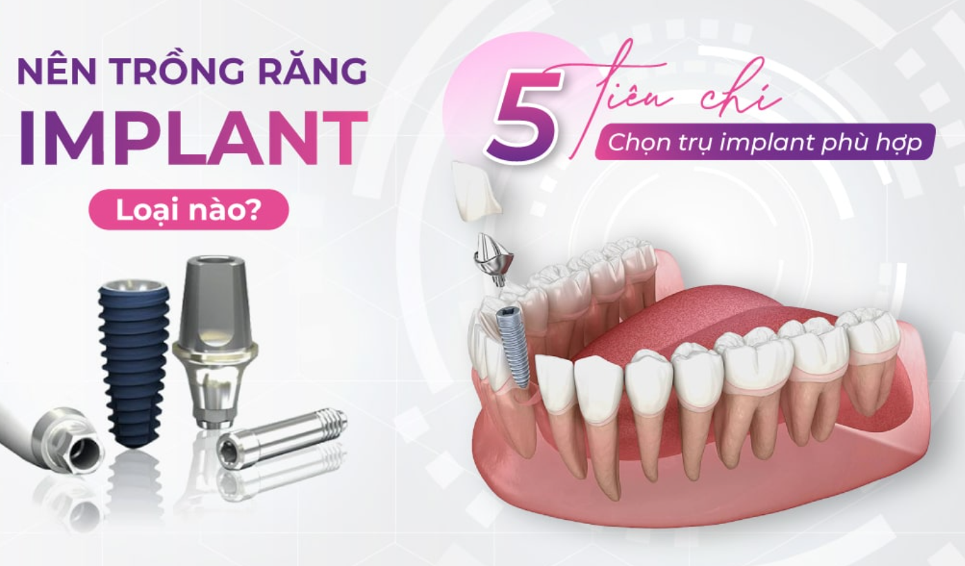các loại trụ Implant