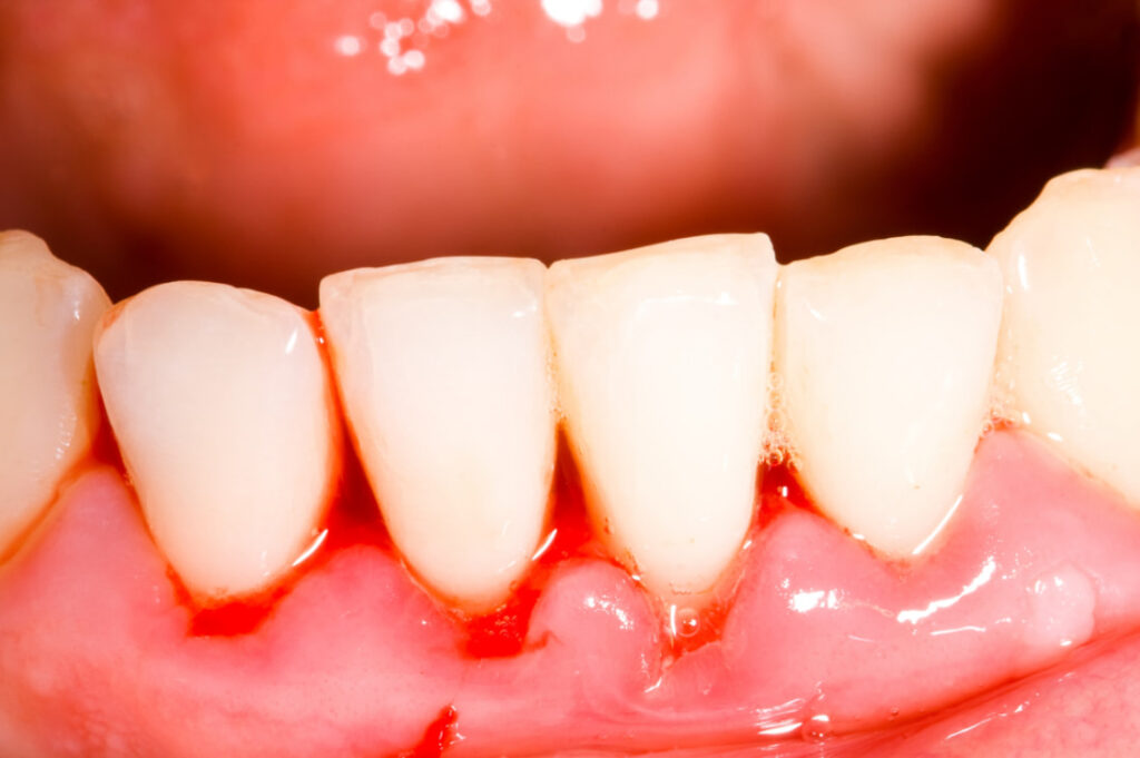 Chảy máu chân răng là bệnh lý về răng miệng