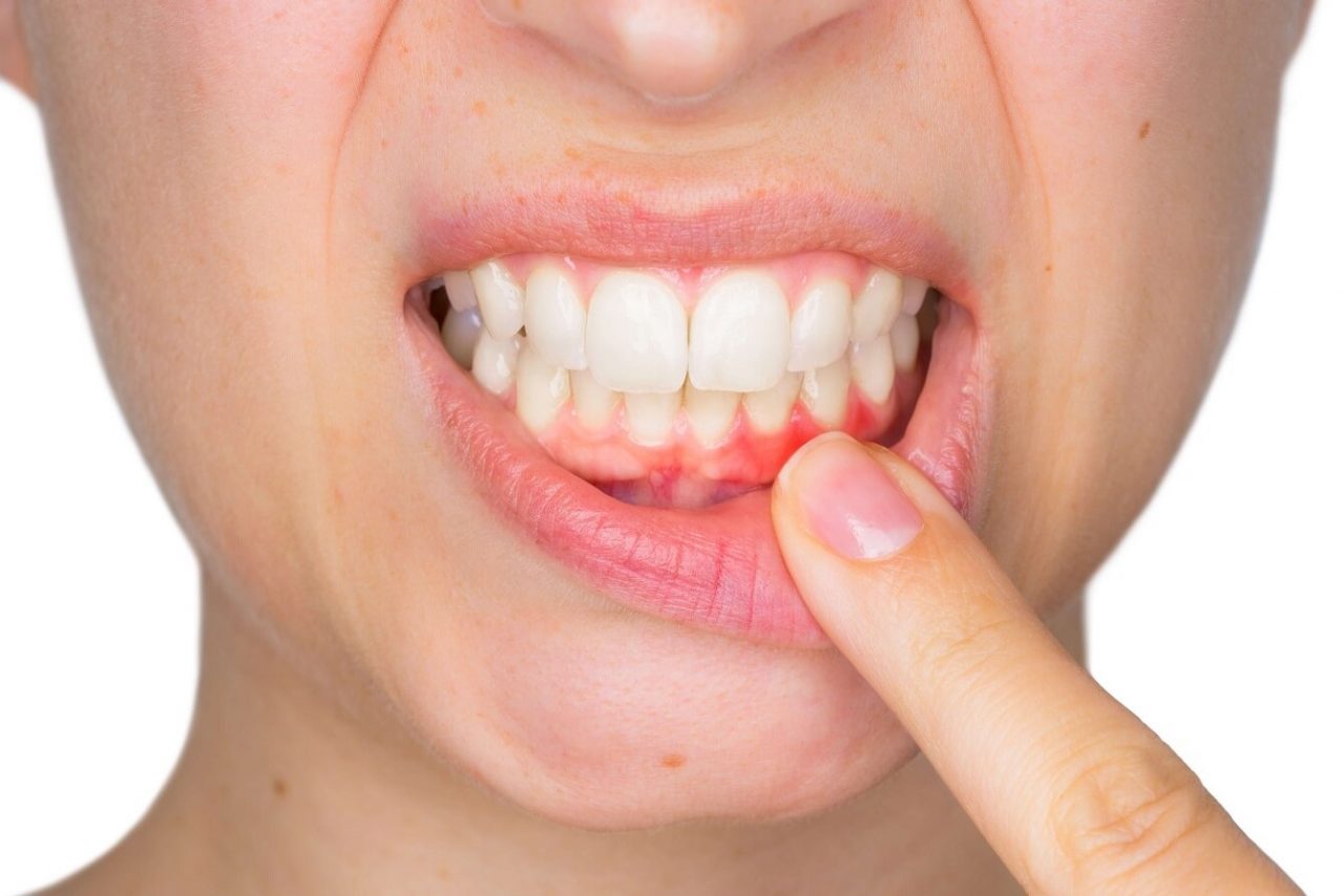 Kích thước giữa các răng không tương xứng
