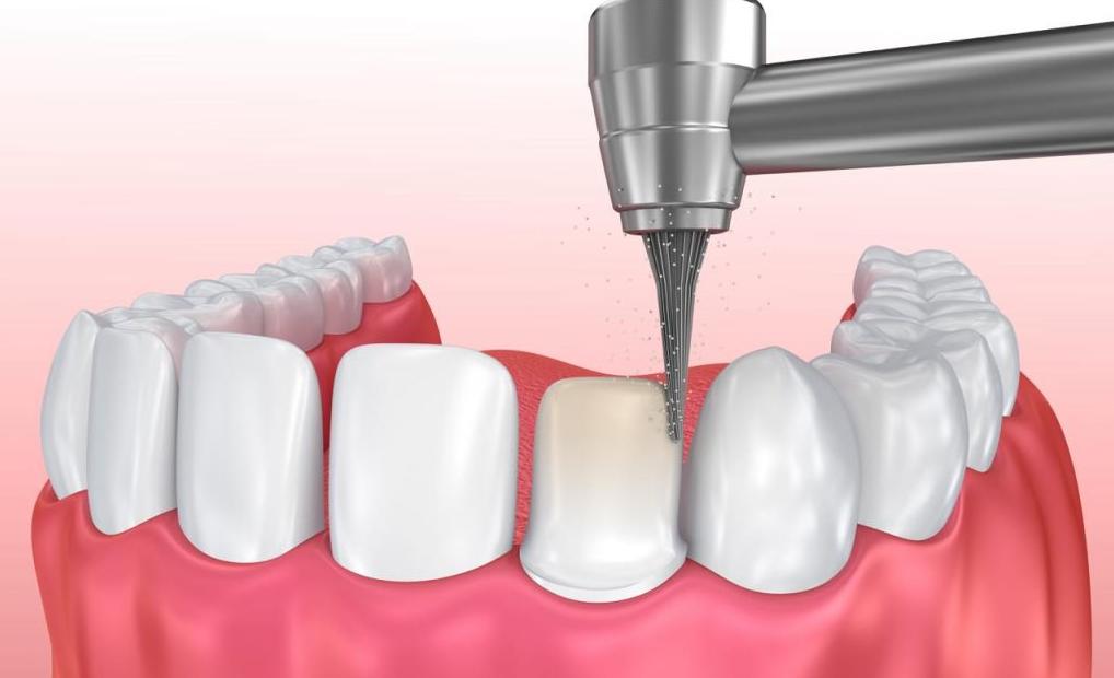 Bọc răng sứ không mài được không