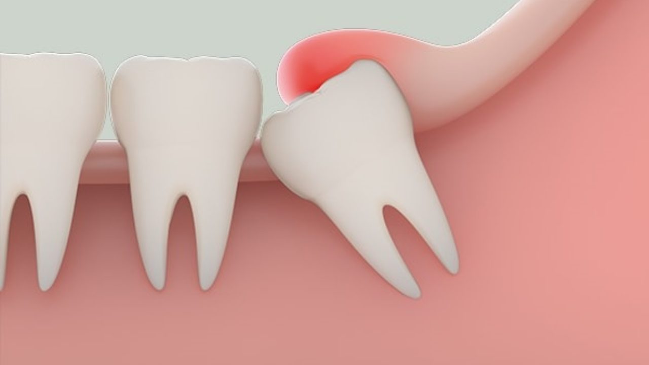 Mọc răng khôn ảnh hưởng đến hàm và chân răng