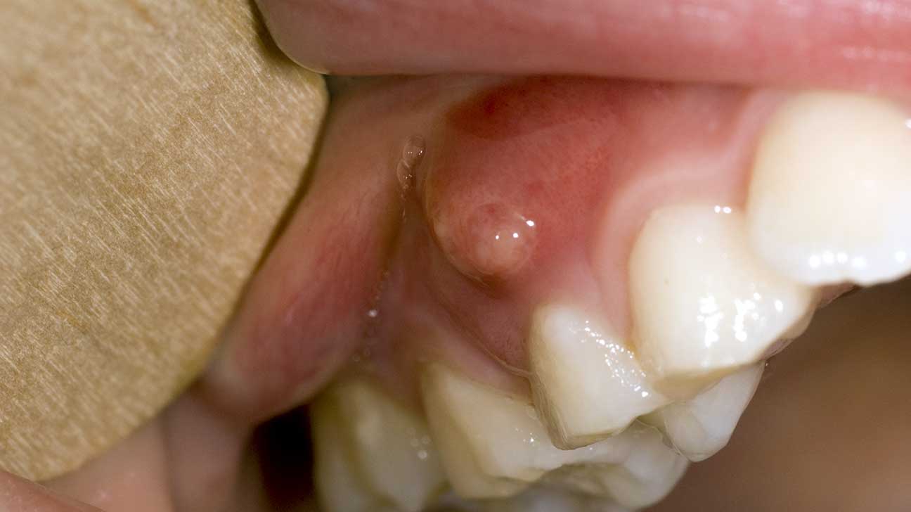 Nang chân răng - Bệnh lý răng miệng cần lưu ý