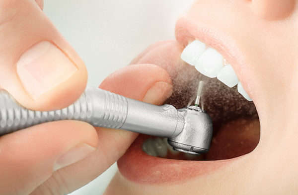 Nên tìm hiểu kỹ trước khi cạo vôi răng