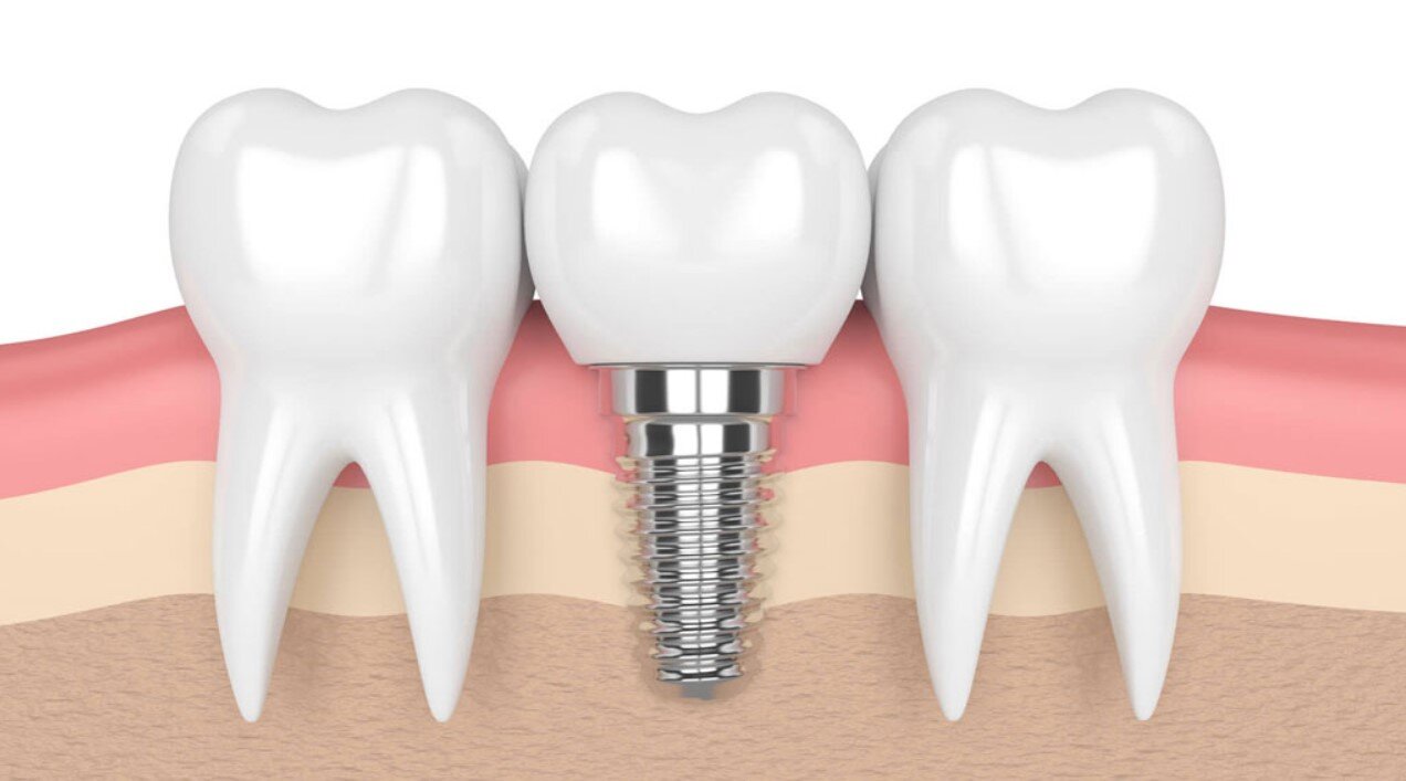 Phương pháp điều trị mục chân răng hiệu quả