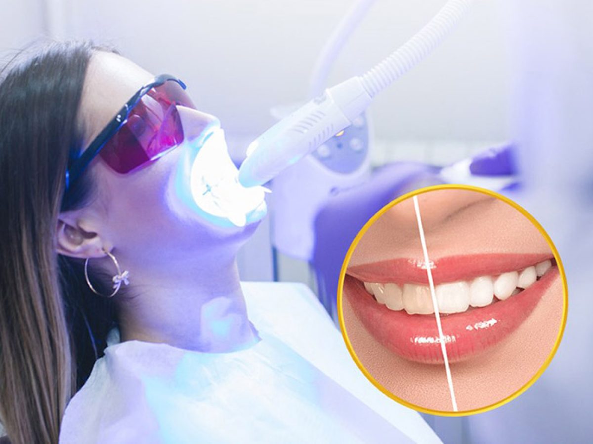 Quy trình tẩy trắng răng chuẩn nha khoa