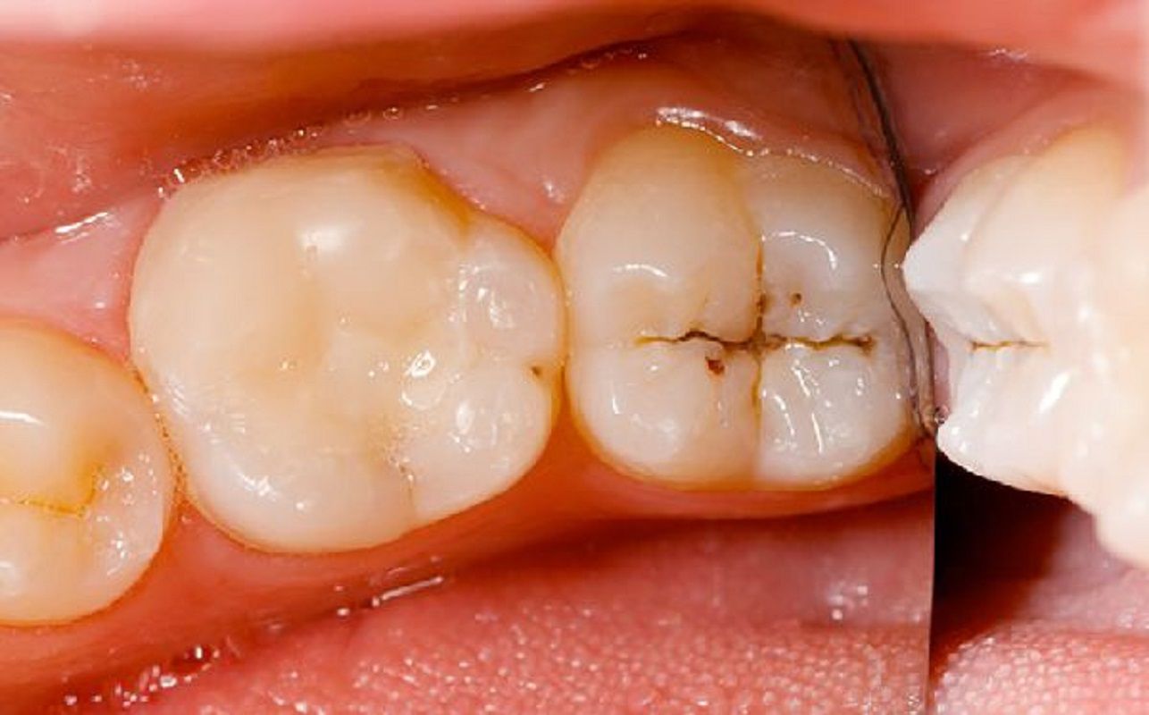 Răng bị sâu có ảnh hưởng đến chân răng