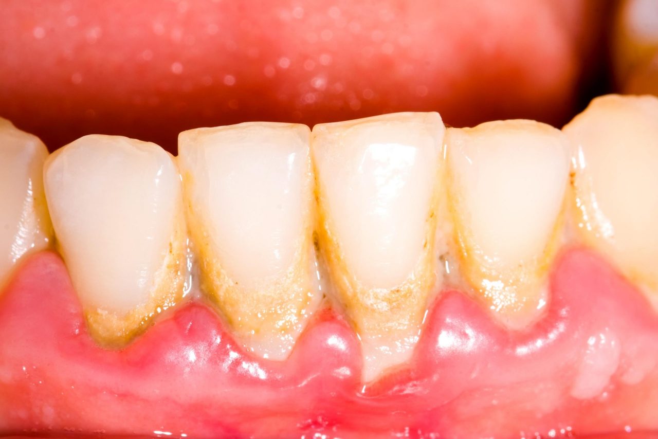Tình trạng chân răng bị mục hay gặp phải