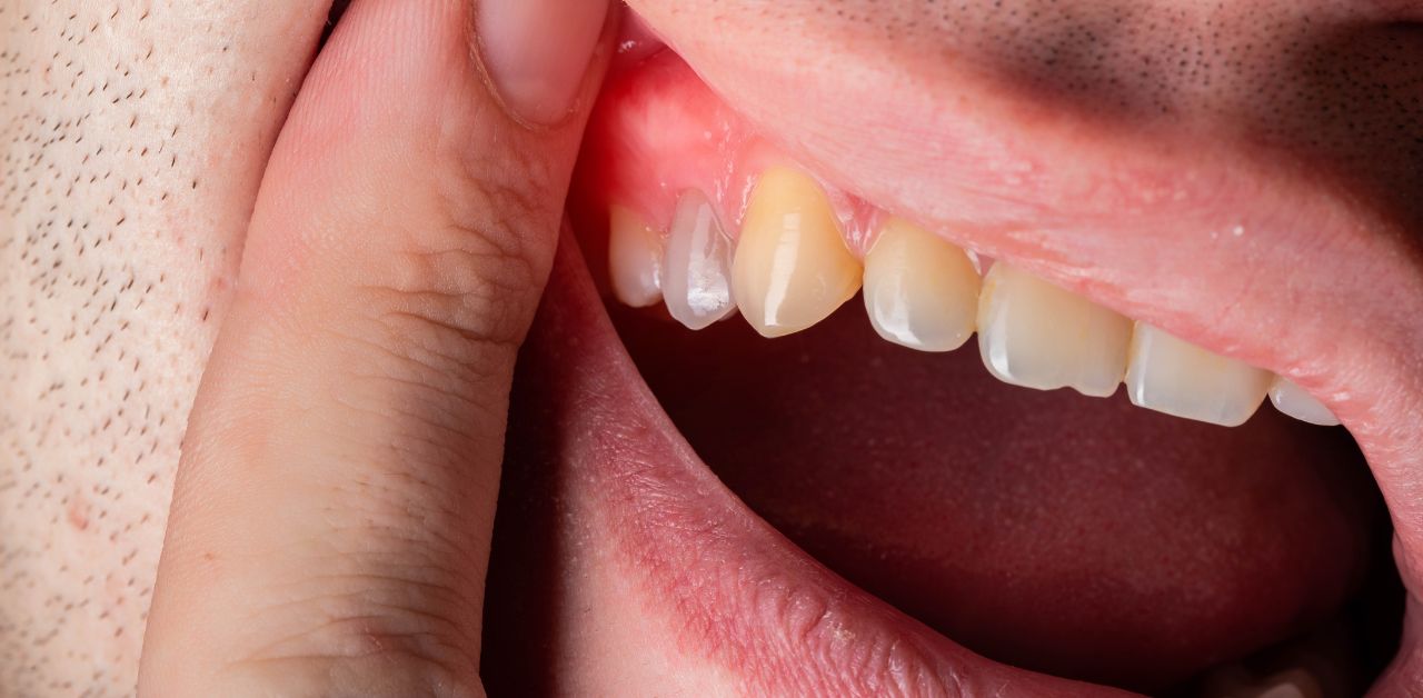 Tình trạng sưng chân răng nặng theo mỗi giai đoạn