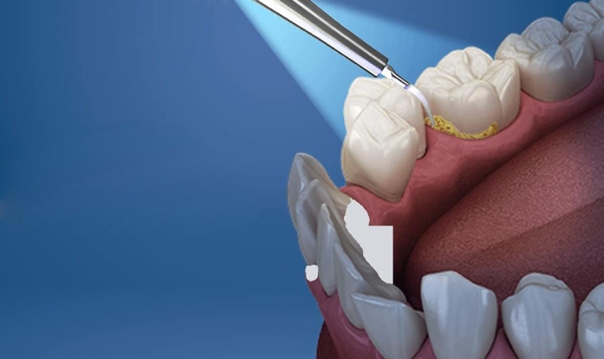 Tình trạng vôi răng có ảnh hưởng đến chi phí