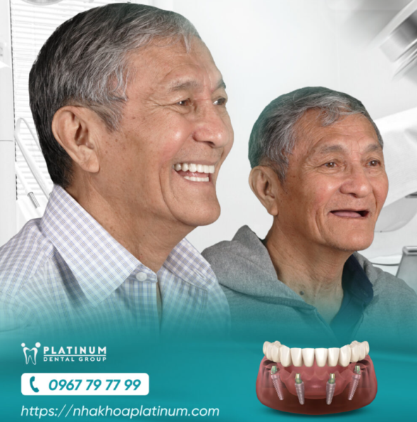 các loại trụ Implant