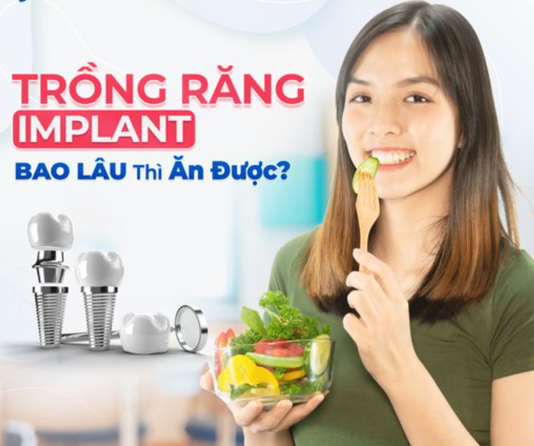 Trồng răng Implant thì bao lâu ăn được