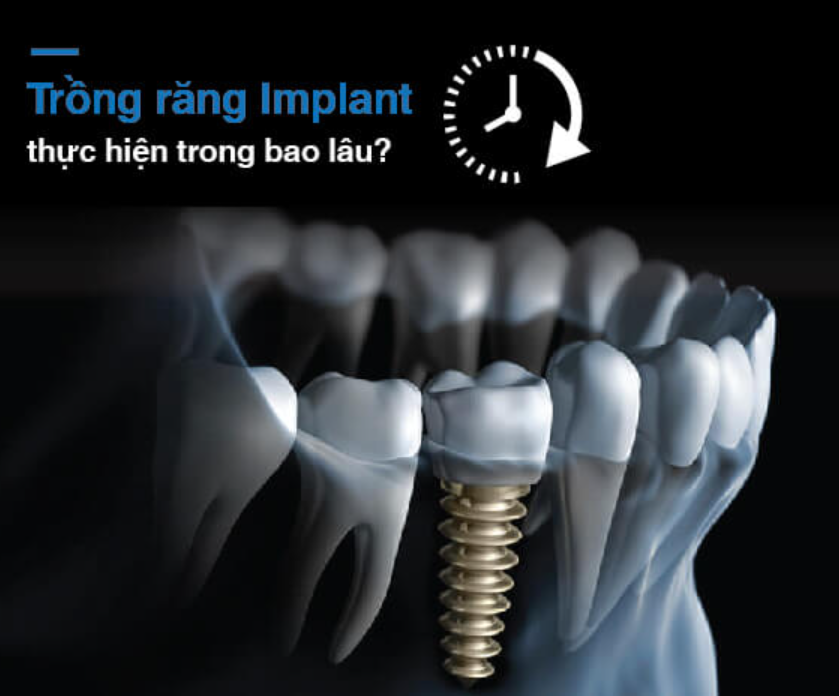Trồng răng Implant mất bao lâu